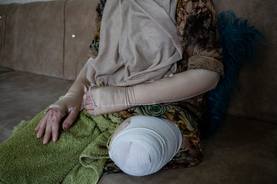 Photograph of the centre part of a woman’s body with bandages. Left leg is amputated.